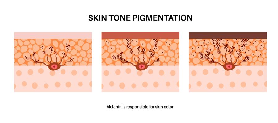 3 Powerful Hyperpigmentation Treatment Methods That Actually Work