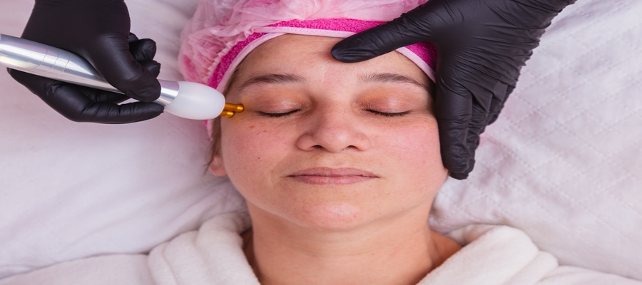 Woman receiving laser, chemical peel, and microneedling treatments for melasma and dark spots