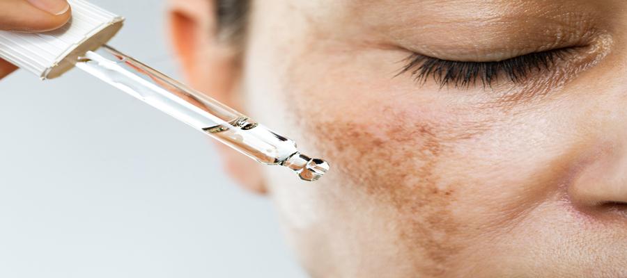 Minimalist Skincare Routine for Melasma