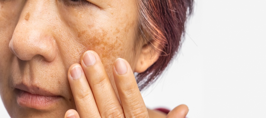 Cellular Senescence About Aging Skin and Age Spots