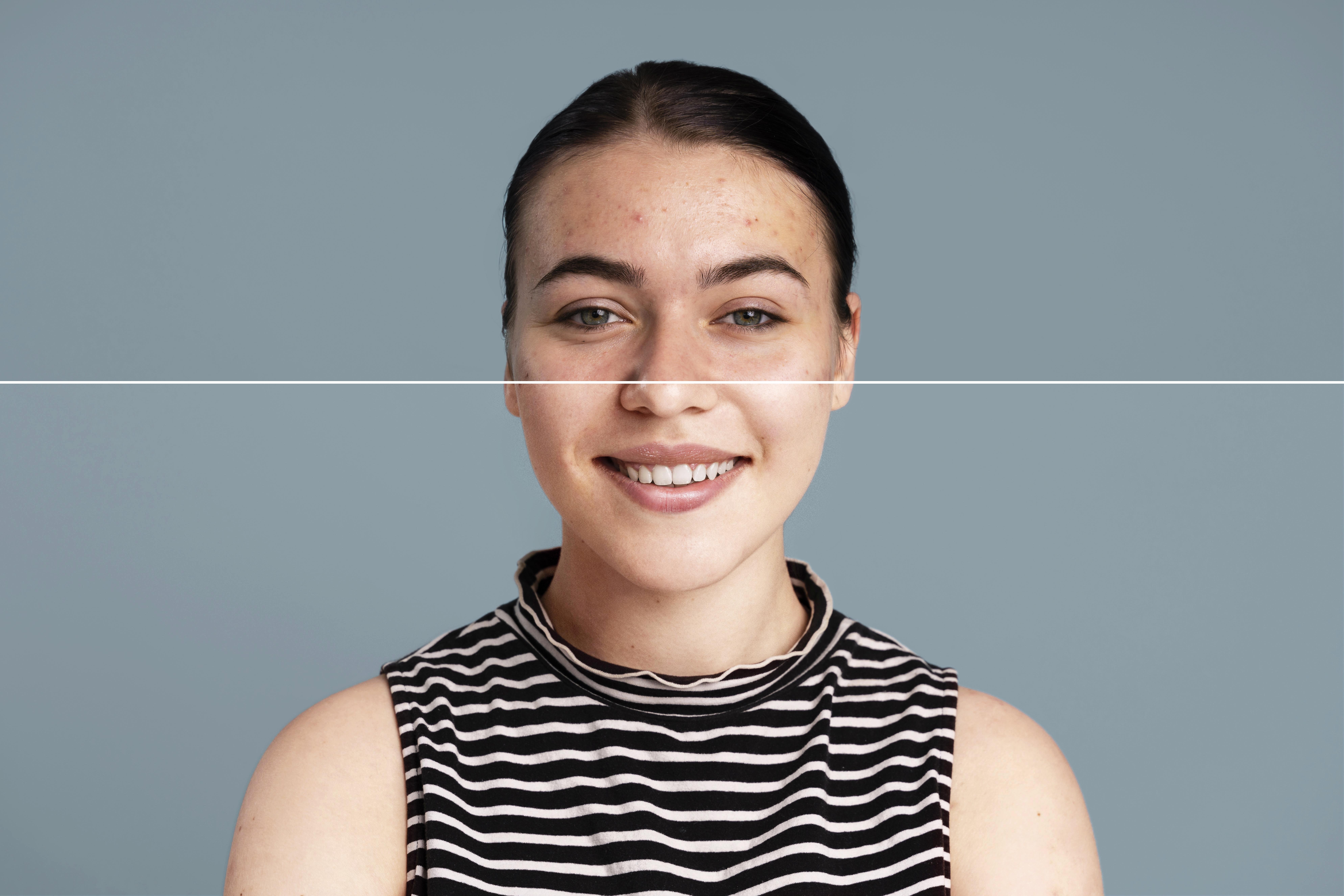 Split-Face Before & After Hyperpigmentation Improvement