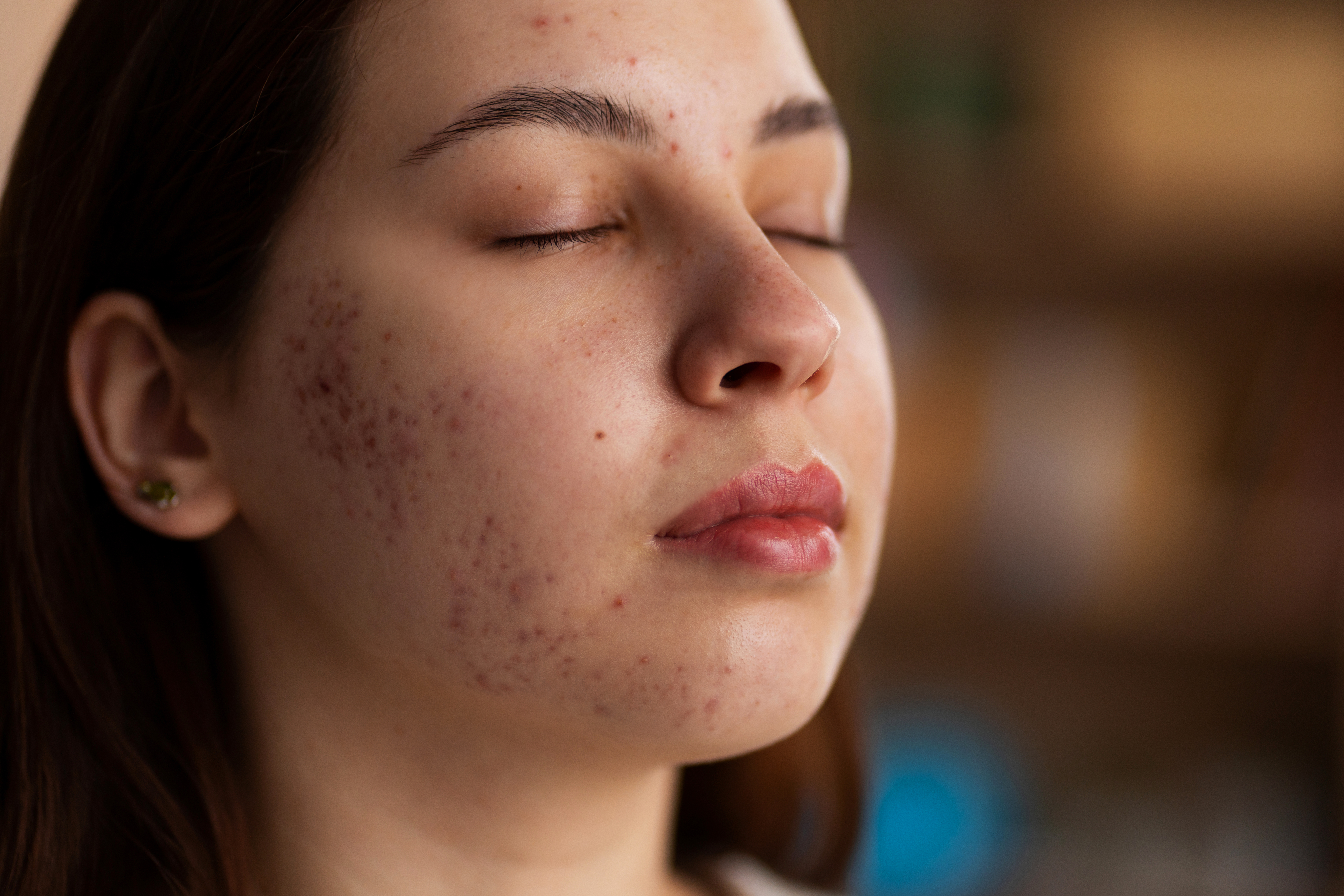 Preventing Melanin Formation Before Dark Spots Appear