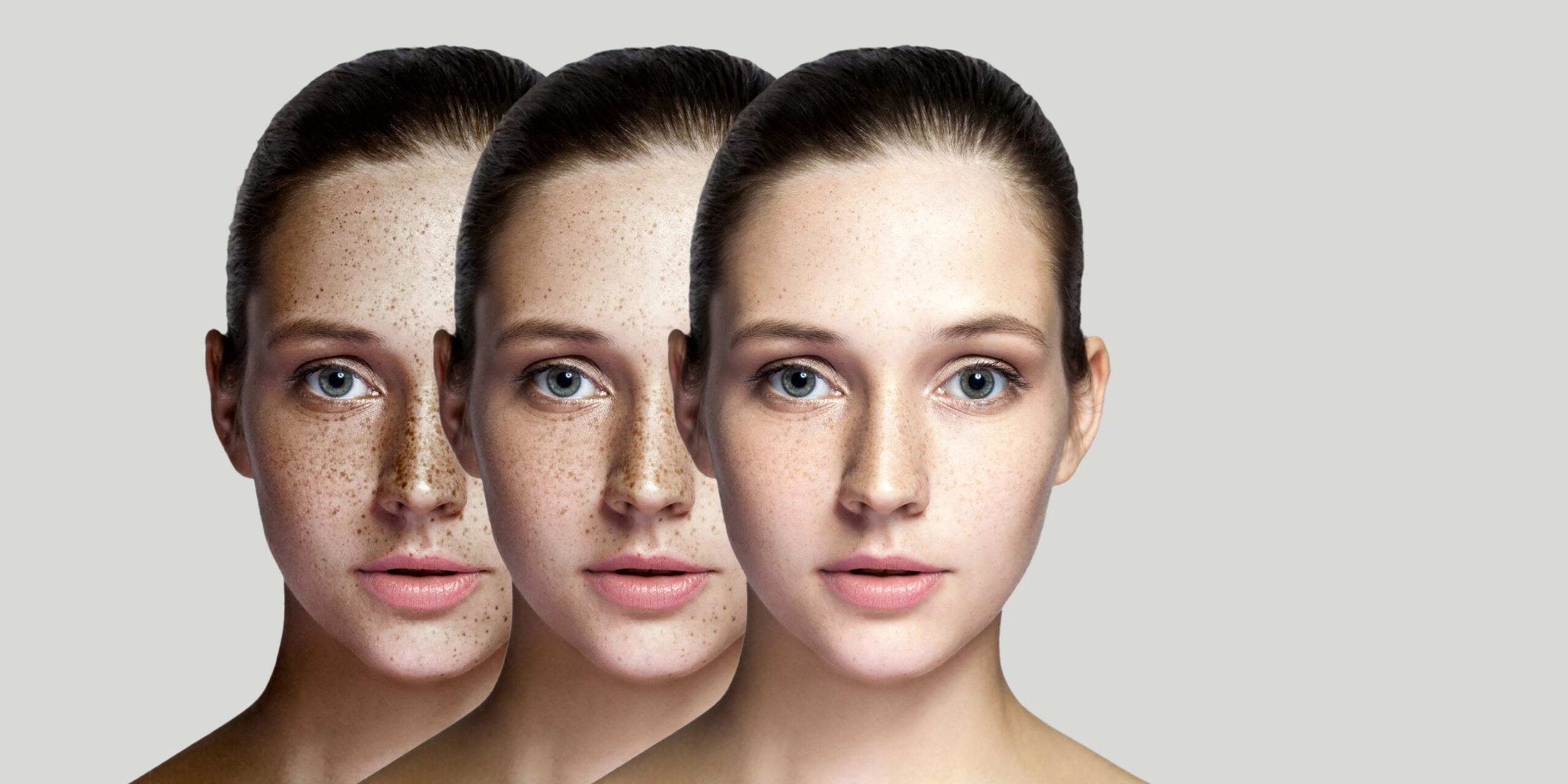 Hyperpigmentation vs Brightening Ingredients – Melanin Reduction and Brighter Skin